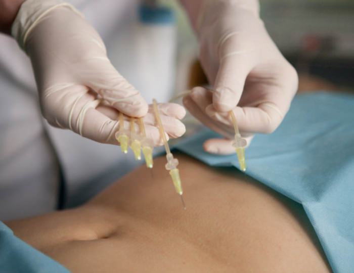 Озонотерапия - Санаторий «Источник» Ессентуки